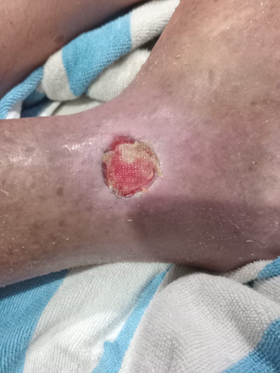 Pengobatan hari ke-1