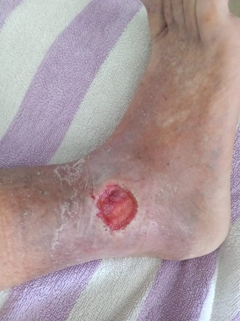 Pengobatan hari ke-10