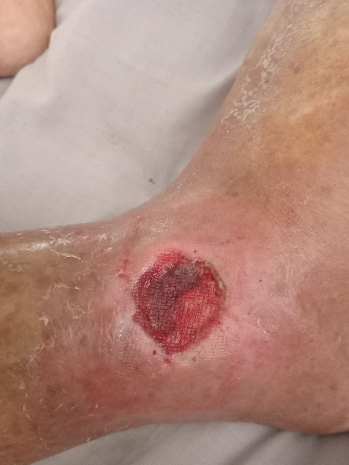 Pengobatan hari ke-11