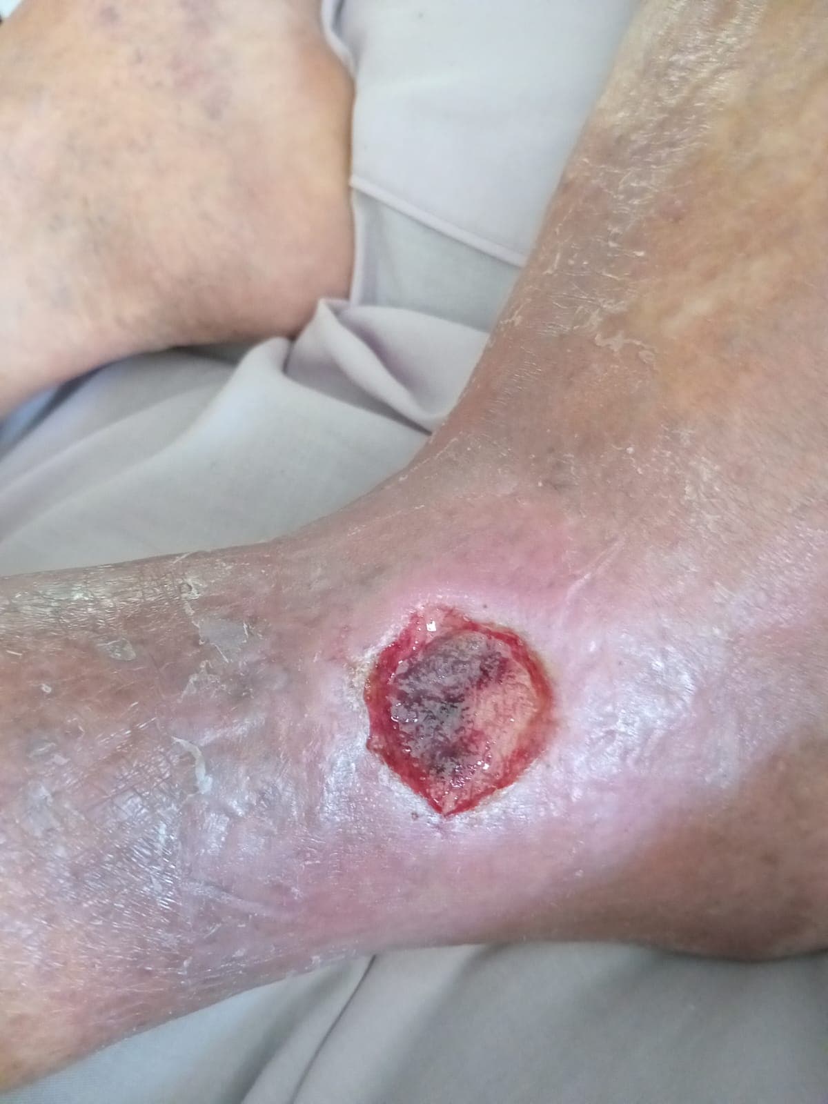 Pengobatan hari ke-13