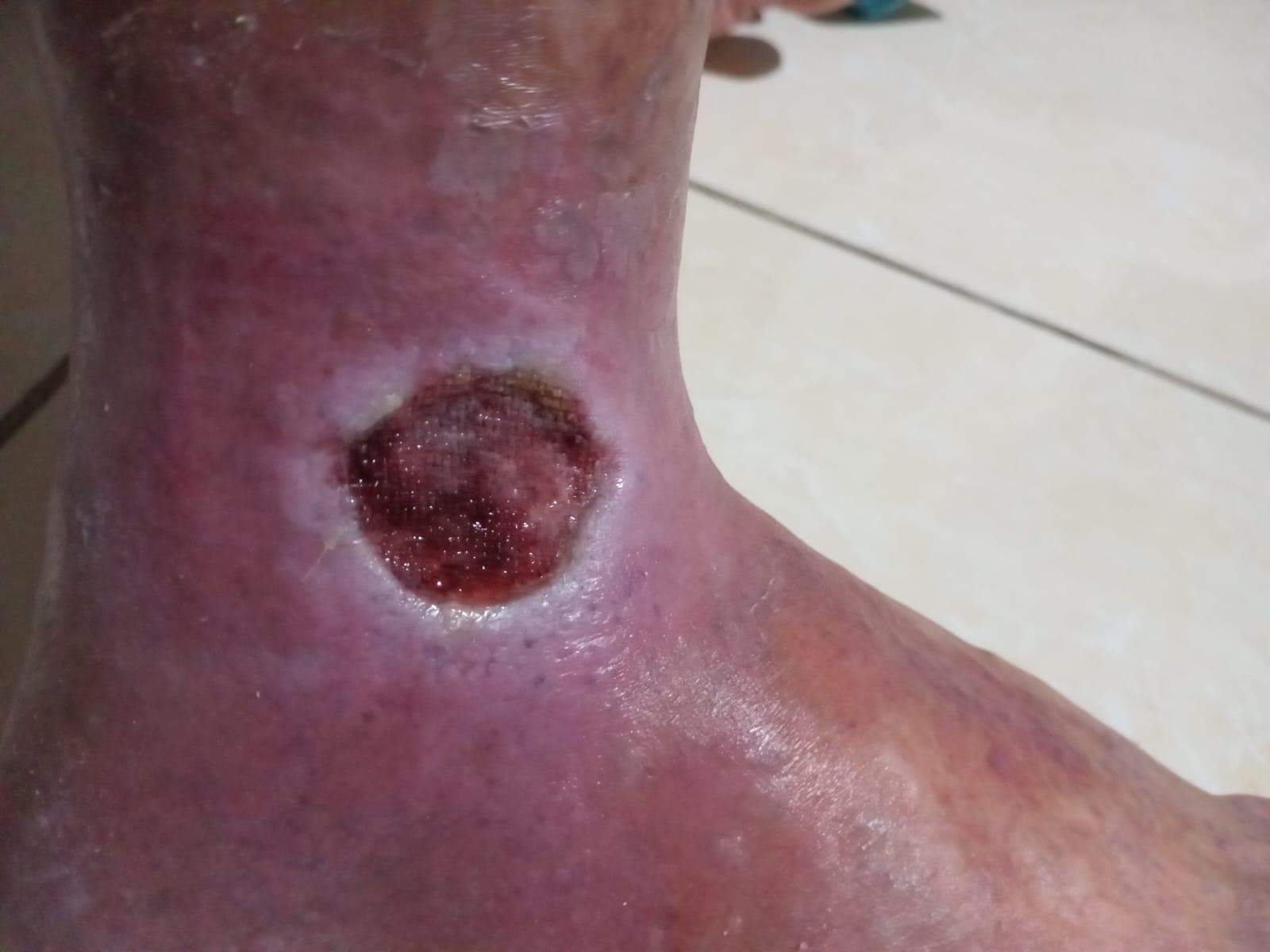 Pengobatan hari ke-14