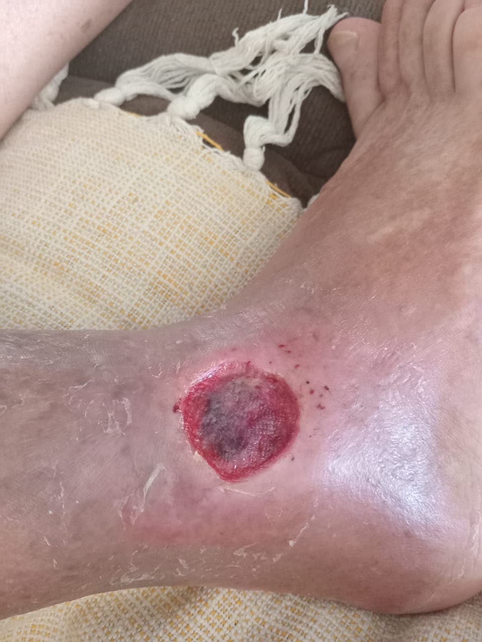 Pengobatan hari ke-17