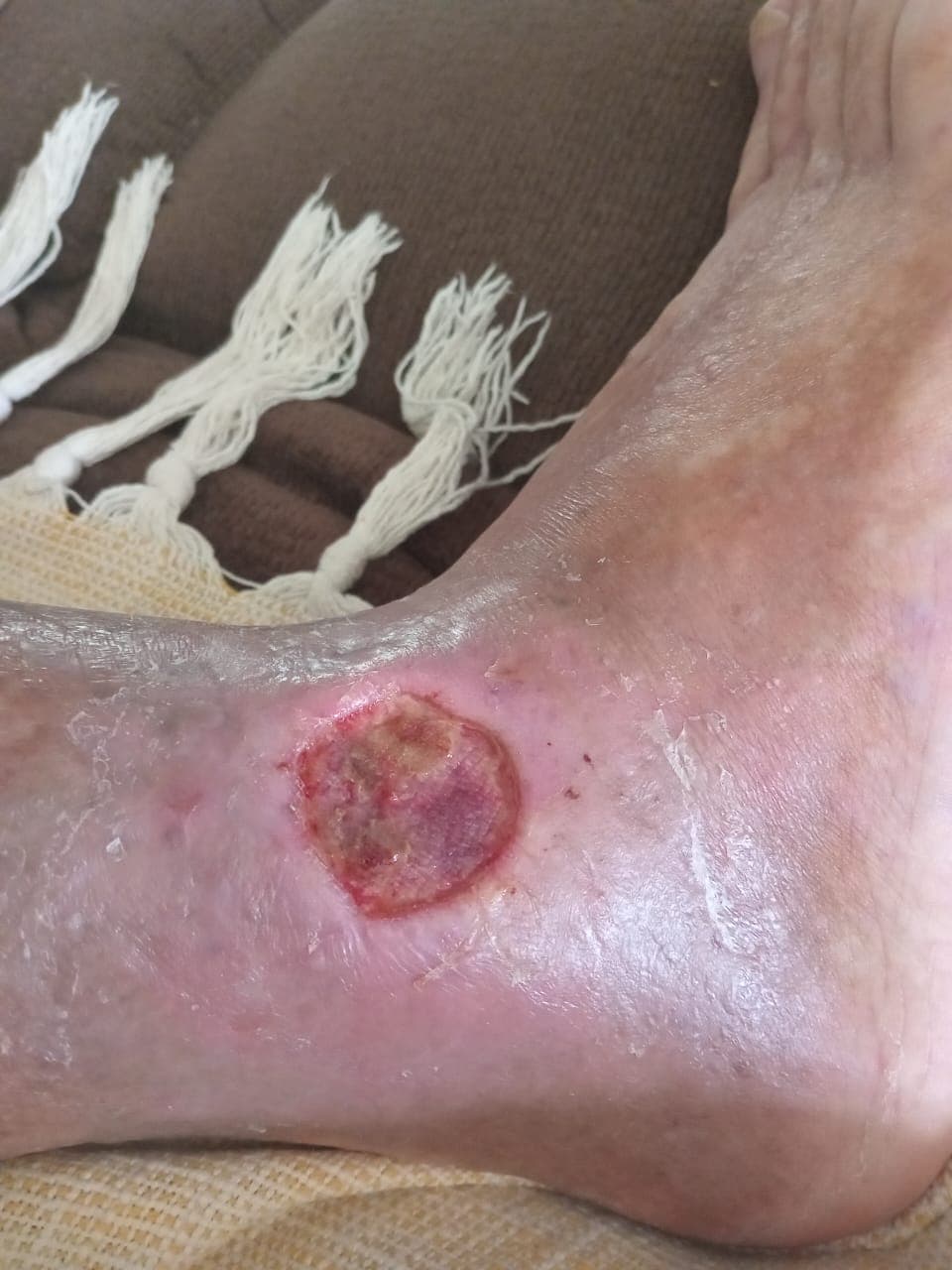 Pengobatan hari ke-19