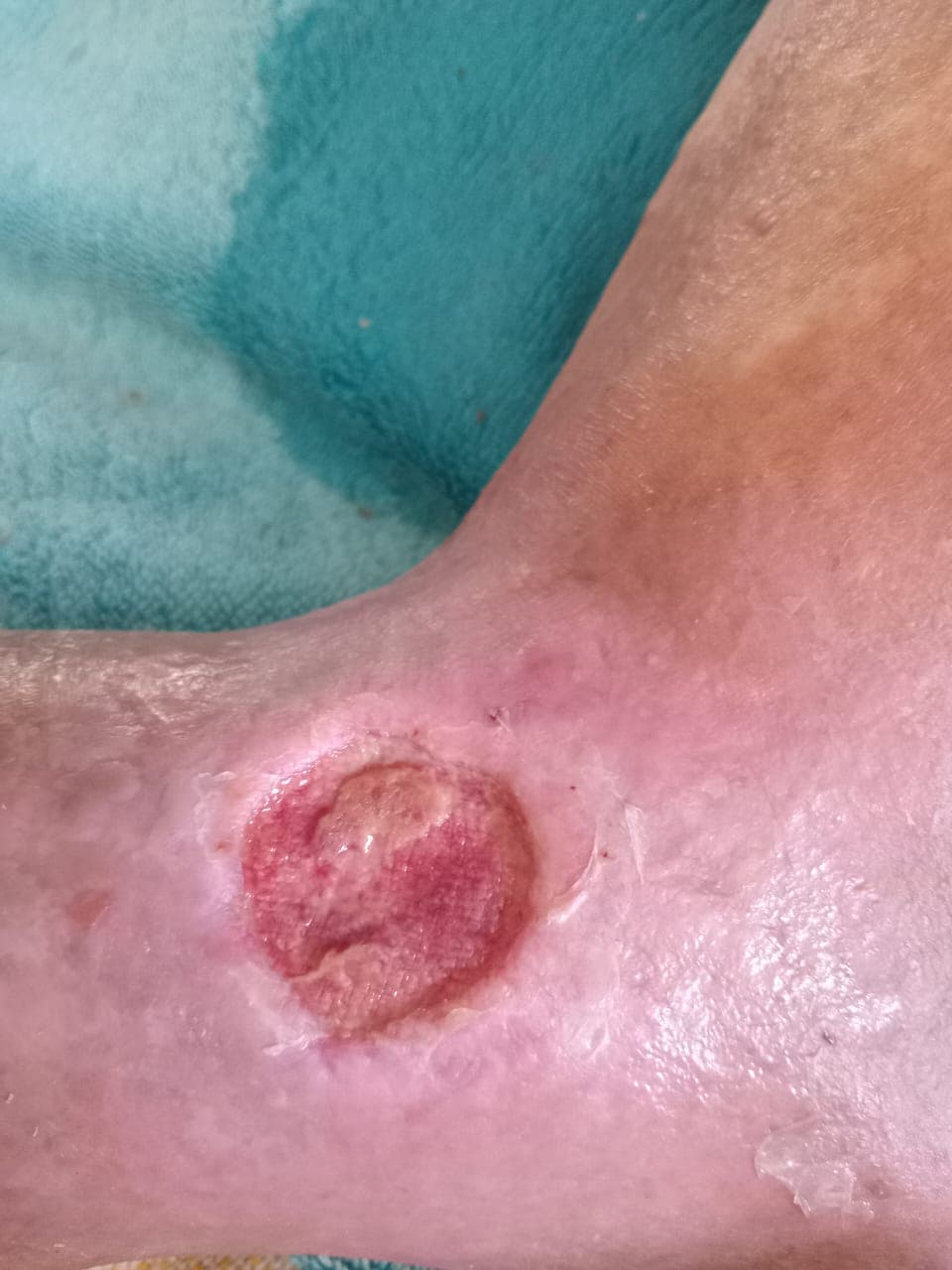 Pengobatan hari ke-20