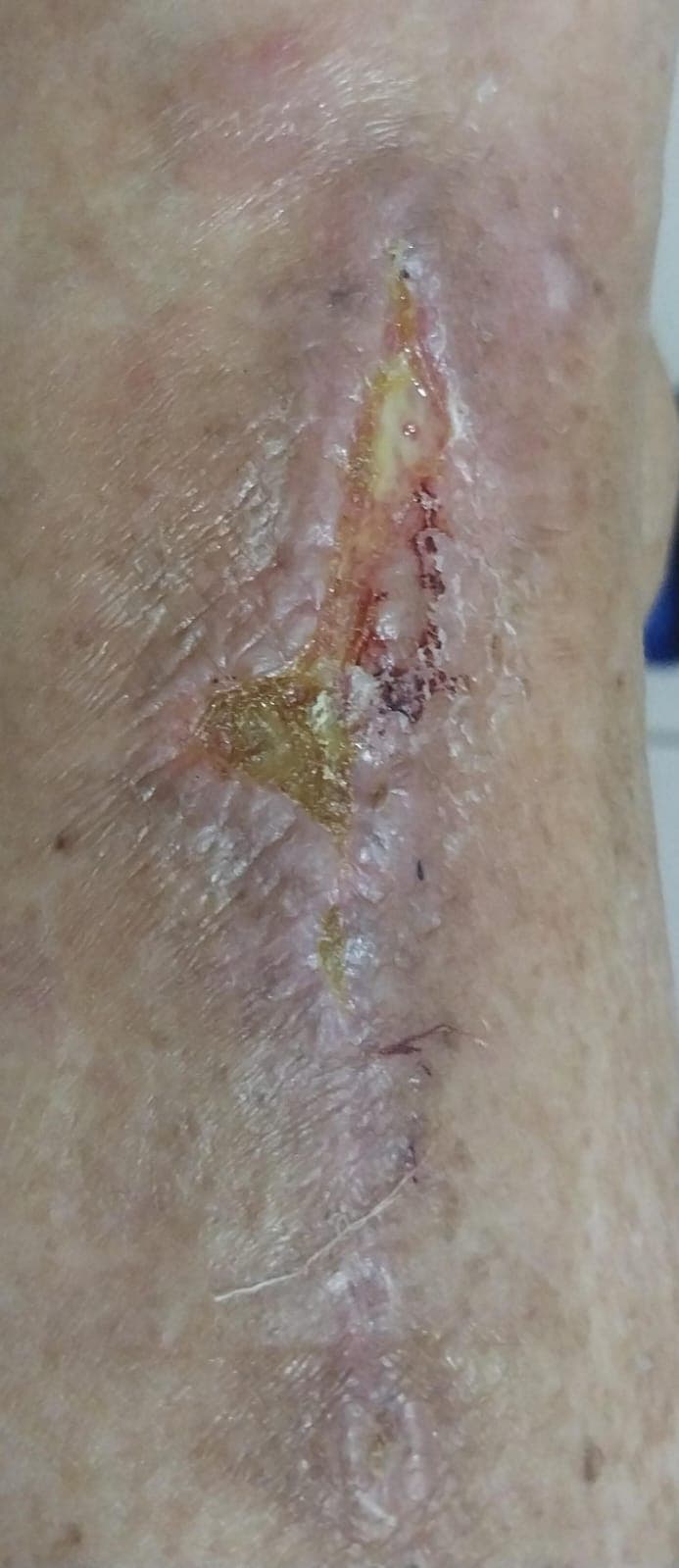 Pengobatan hari ke-3